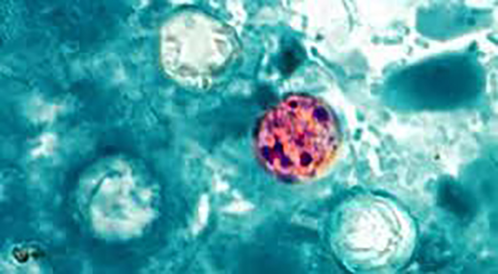 Cyclosporiasis map: 29 states now investigating diarrheal illness